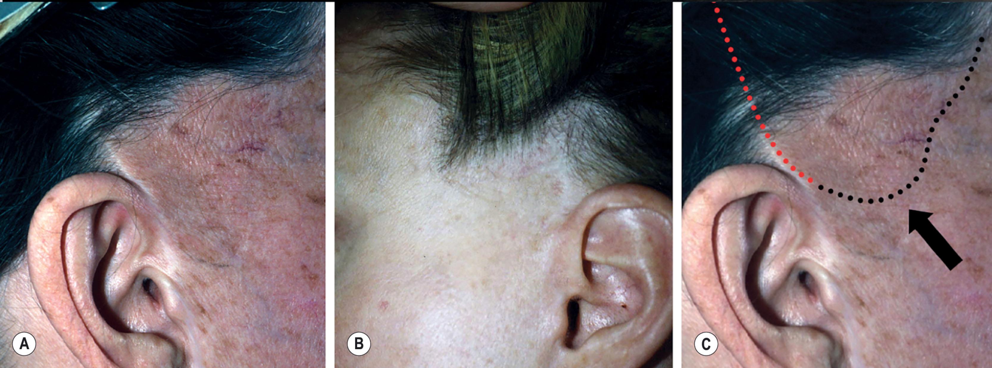 Figure 9.8.6, Displacement of the sideburn and temple hair due to poor incision planning. (A,B) The temporal portion of the facelift incision was made in the temporal scalp (red dotted line in C) in a well-intended but conceptually flawed effort to hide the resulting scar. Because cheek flap redundancy was large and skin elasticity poor, advancement of the cheek skin flap has resulted in objectionable and tell-tale hairline displacement. An incision along the hairline would have prevented this occurrence (black dotted line in C). (Procedures performed by unknown surgeons.) (C) Deconstruction of cause of temporal hairline displacement seen in A and B. The operating surgeon made an error in planning. He or she made a well-intended effort to hide the temporal portion of the facelift incision in the temporal scalp (red dotted line), but underestimated or did not appreciate the amount of skin redundancy over the upper lateral cheek. When the facelift skin flap was advanced (black arrow) skin was moved into an area were scalp and hair should be present. The black dotted line shows the incision plan that would have prevented this occurrence. (Procedure performed by an unknown surgeon.)