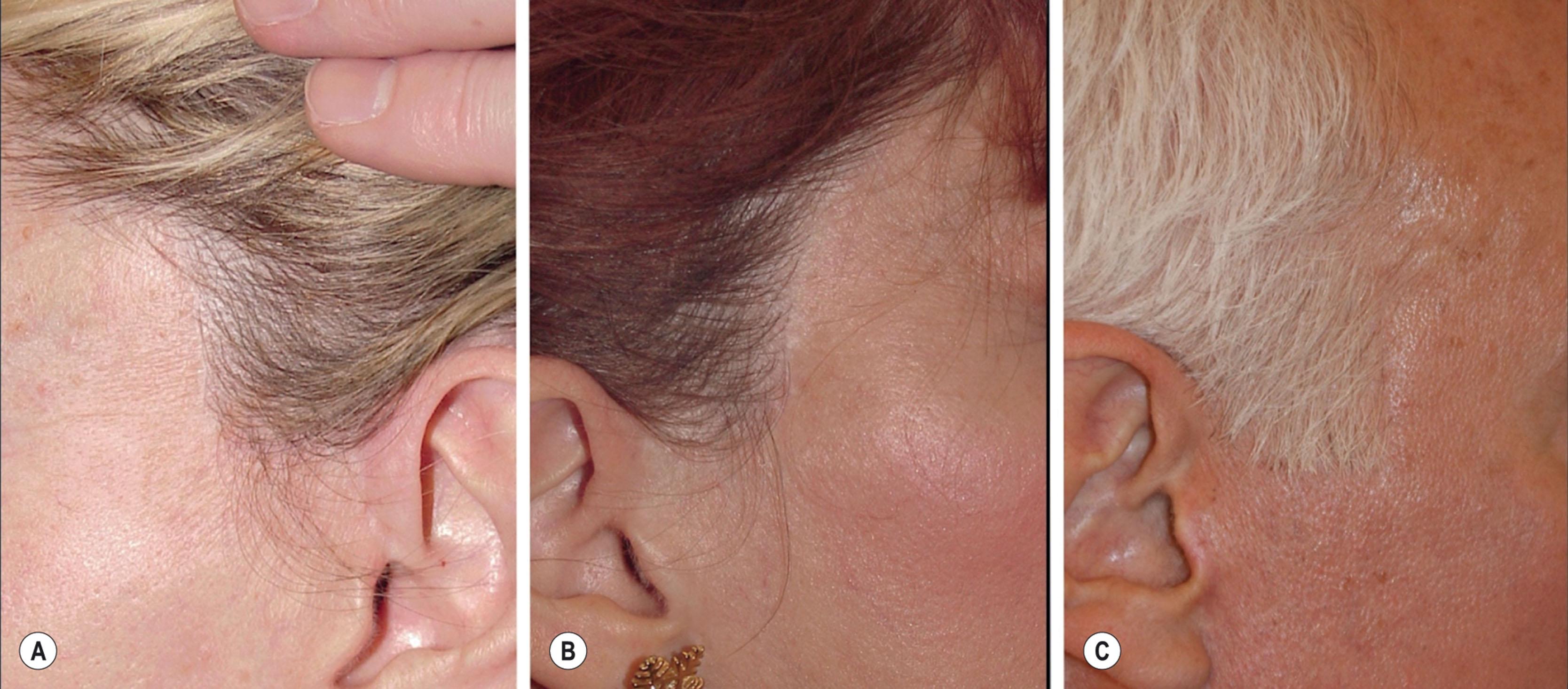 Figure 9.8.7, Healed incisions along the temporal hairline. The use of an incision along the hairline, when indicated, can prevent posterior and superior hairline and sideburn displacement without compromising the end result. Although a fine scar is present along the hairline in each of these patients, it is not evident upon casual inspection. Note the preservation of lush temple hair and a full, youthful, natural-appearing sideburn (compare with Fig. 9.8.6A–C ).