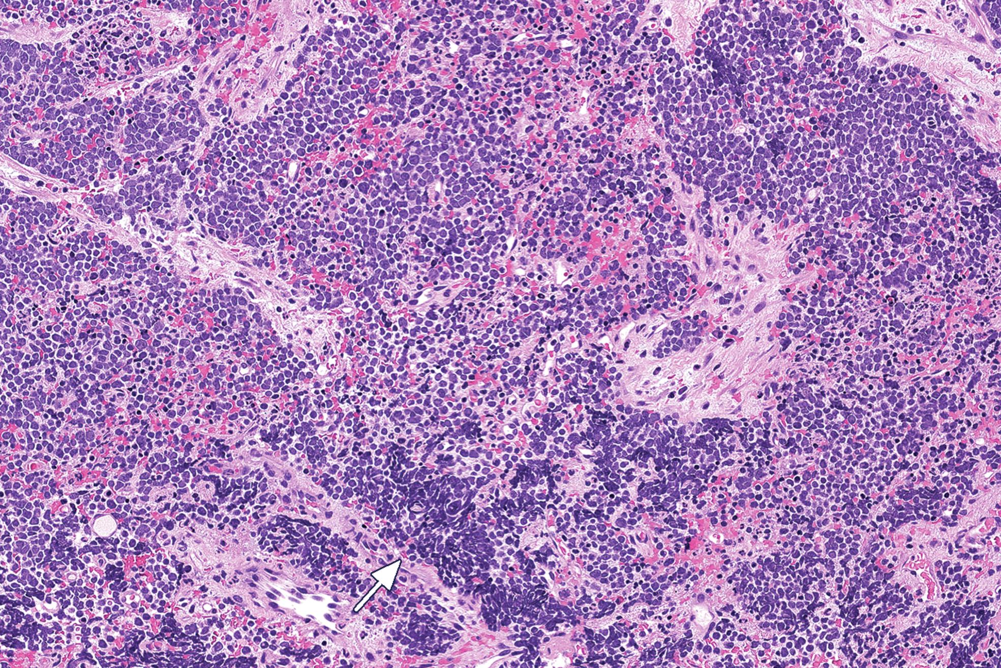 Fig. 14.2, Small cell neuroendocrine carcinoma showing tumor cells with high nuclear-cytoplasmic ratio and crush artifact (arrow).