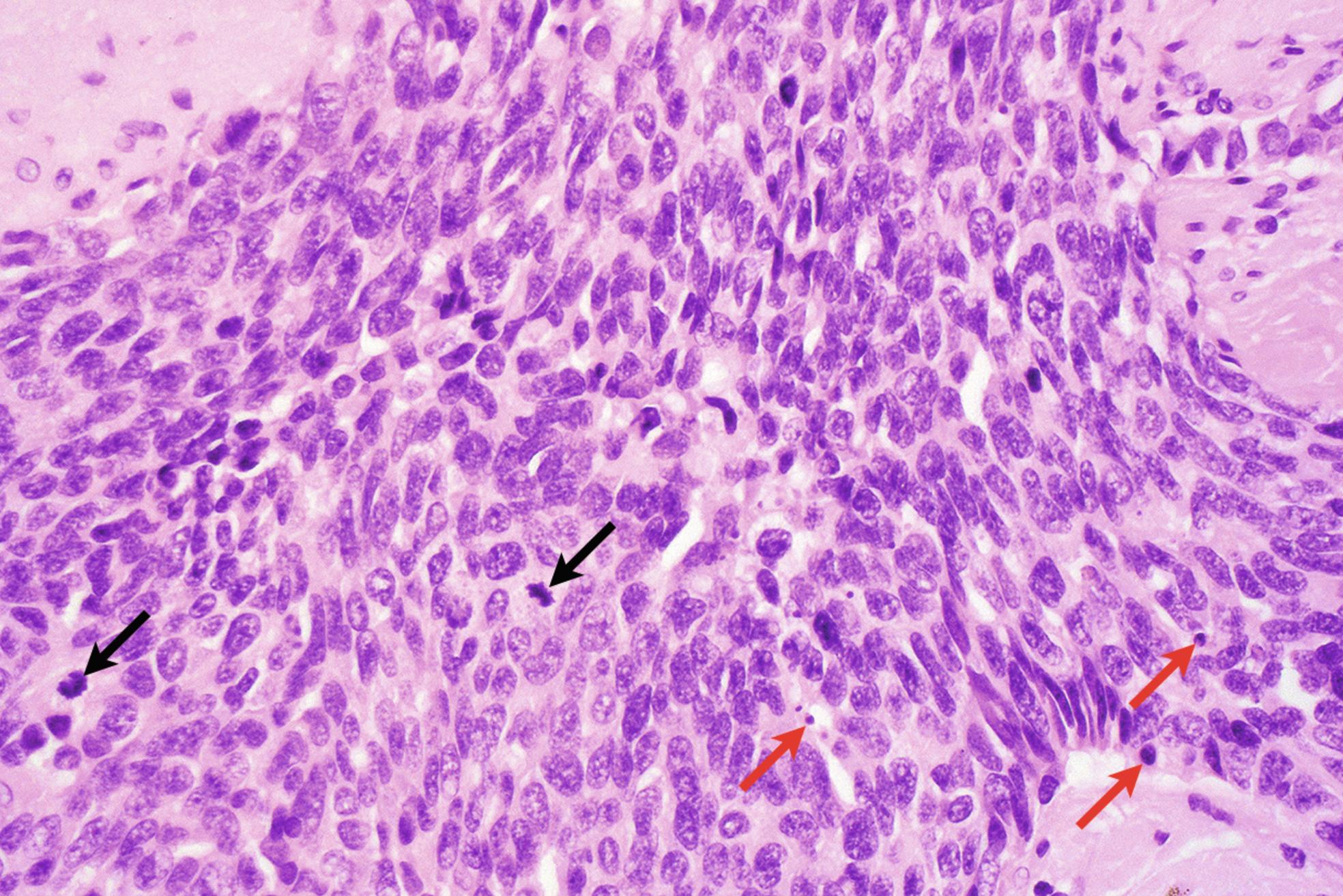Fig. 14.3, Small cell neuroendocrine carcinoma showing tumor cells with high N/C ratio, salt and pepper chromatin, frequent mitoses ( black arrows ), and apoptotic bodies ( red arrows ).