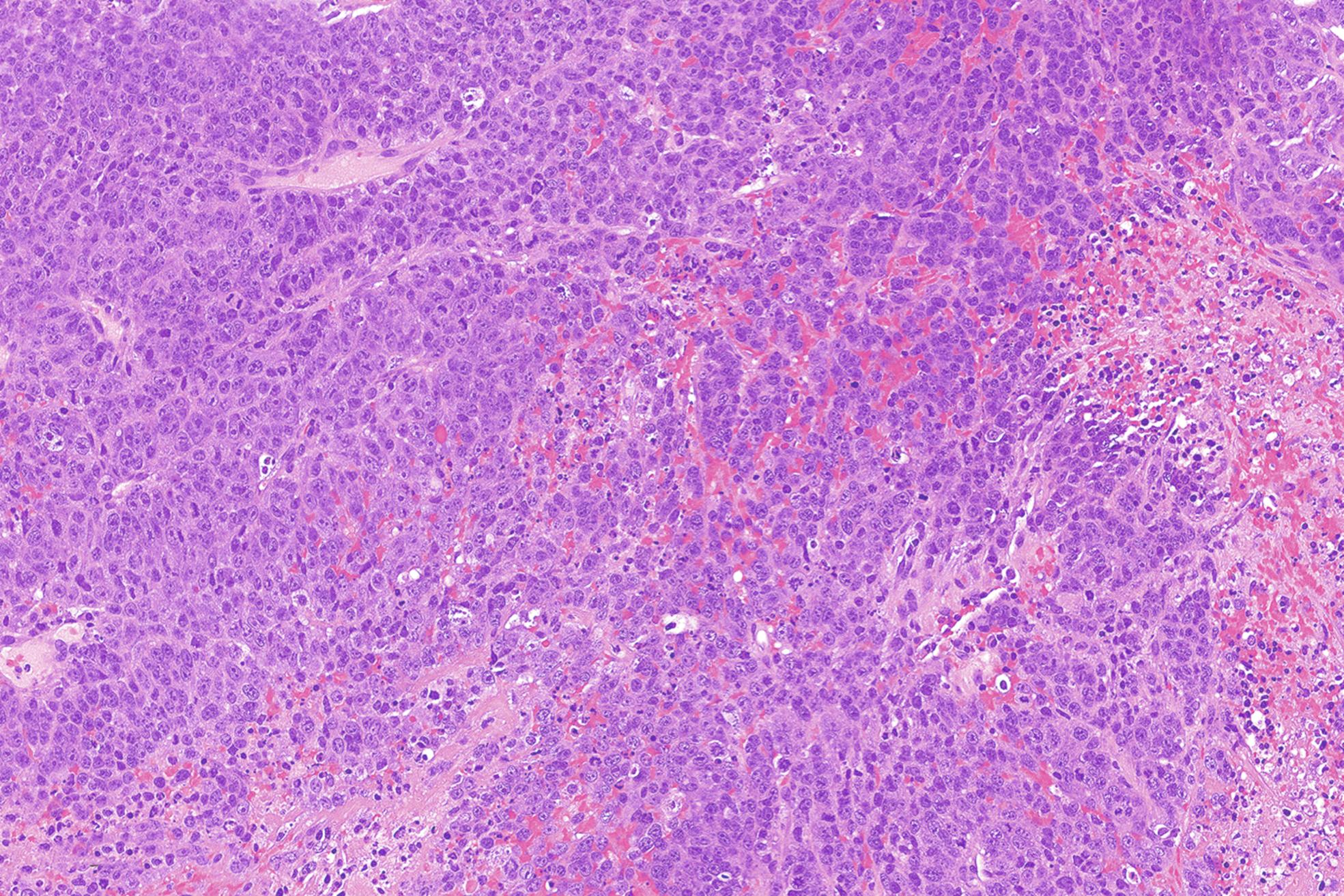 Fig. 14.4, Large cell neuroendocrine carcinoma showing nested and trabecular pattern composed of cells with moderate amounts of cytoplasm and prominent nucleoli.