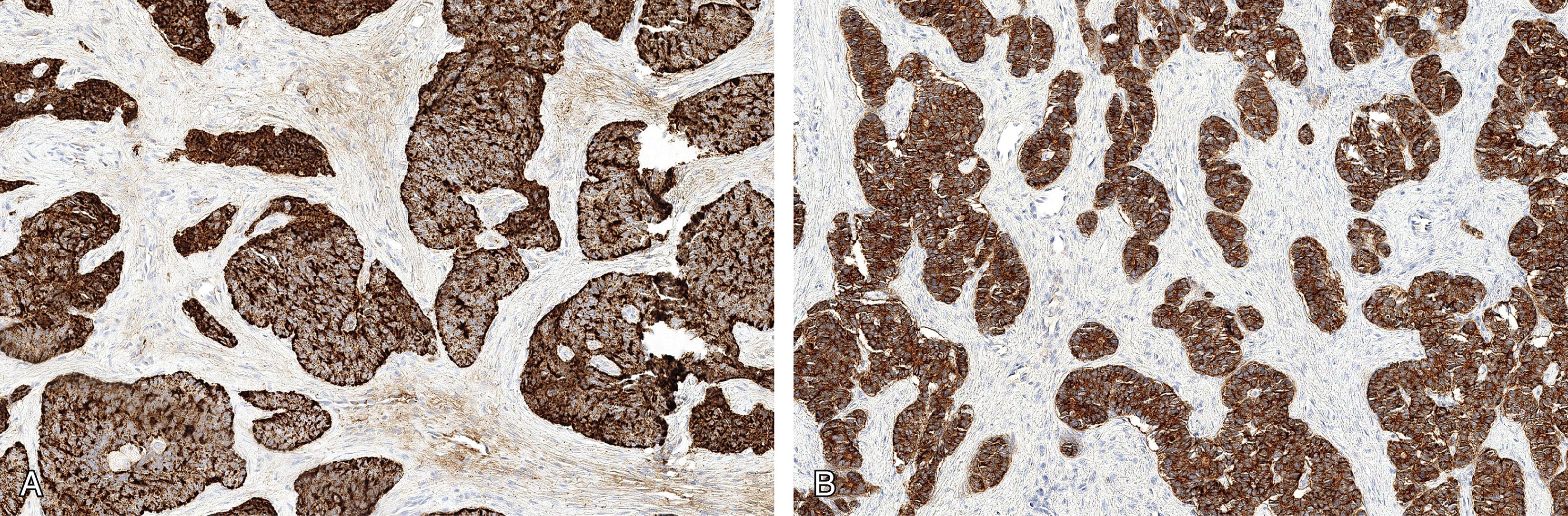 Fig. 14.5, Small cell neuroendocrine carcinoma showing diffuse staining for synaptophysin (A) and chromogranin (B).