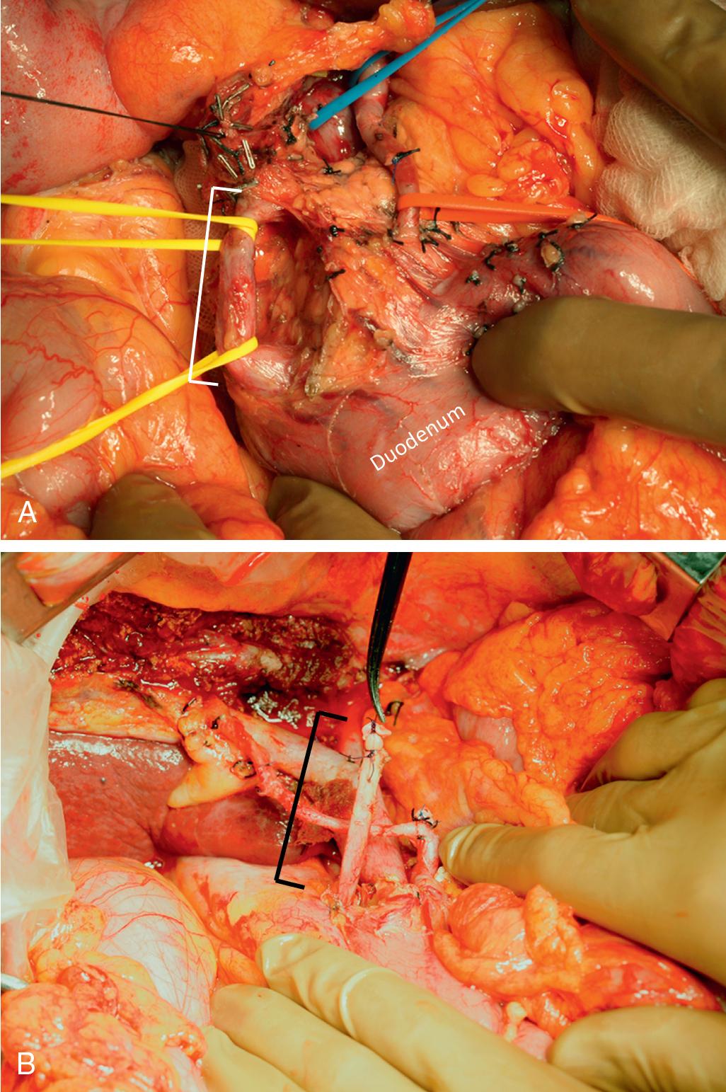 FIGURE 119B.2, Standard resection of perihilar cholangiocarcinoma.