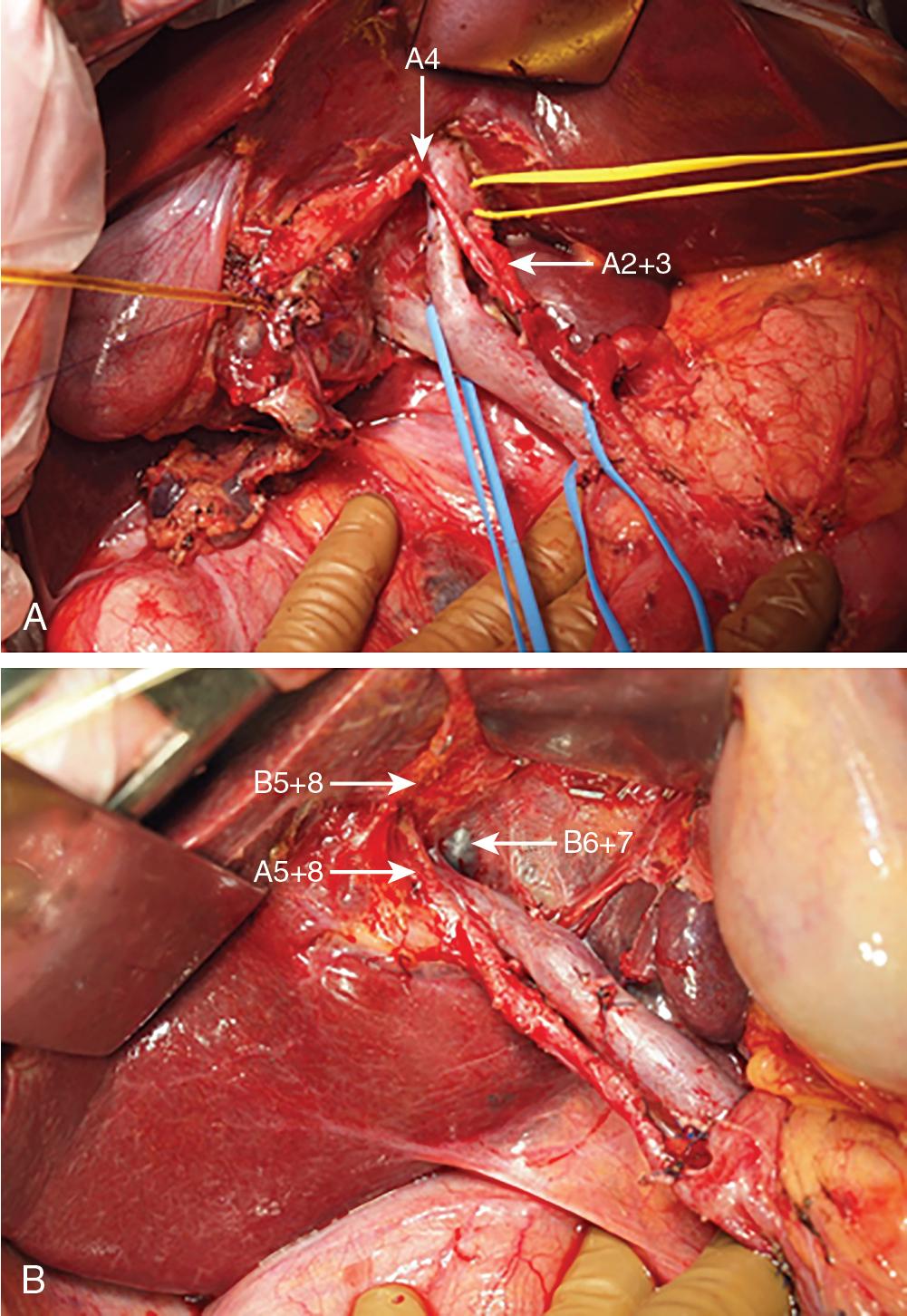 FIGURE 119B.3, A, Hilar dissection during right hepatectomy. The left hepatic artery and the left portal vein are freed from the left biliary ductal system. Arantius’ duct is identified with yellow tape; the right portal vein (with blue tape) is about to be divided. B, Hilar dissection during left hepatectomy. The right anterior hepatic artery (A5+8) and the right portal vein are freed from the right biliary ductal system. The numerals indicate the hepatic segment according to the Couinaud classification. A, hepatic artery; B, bile duct.