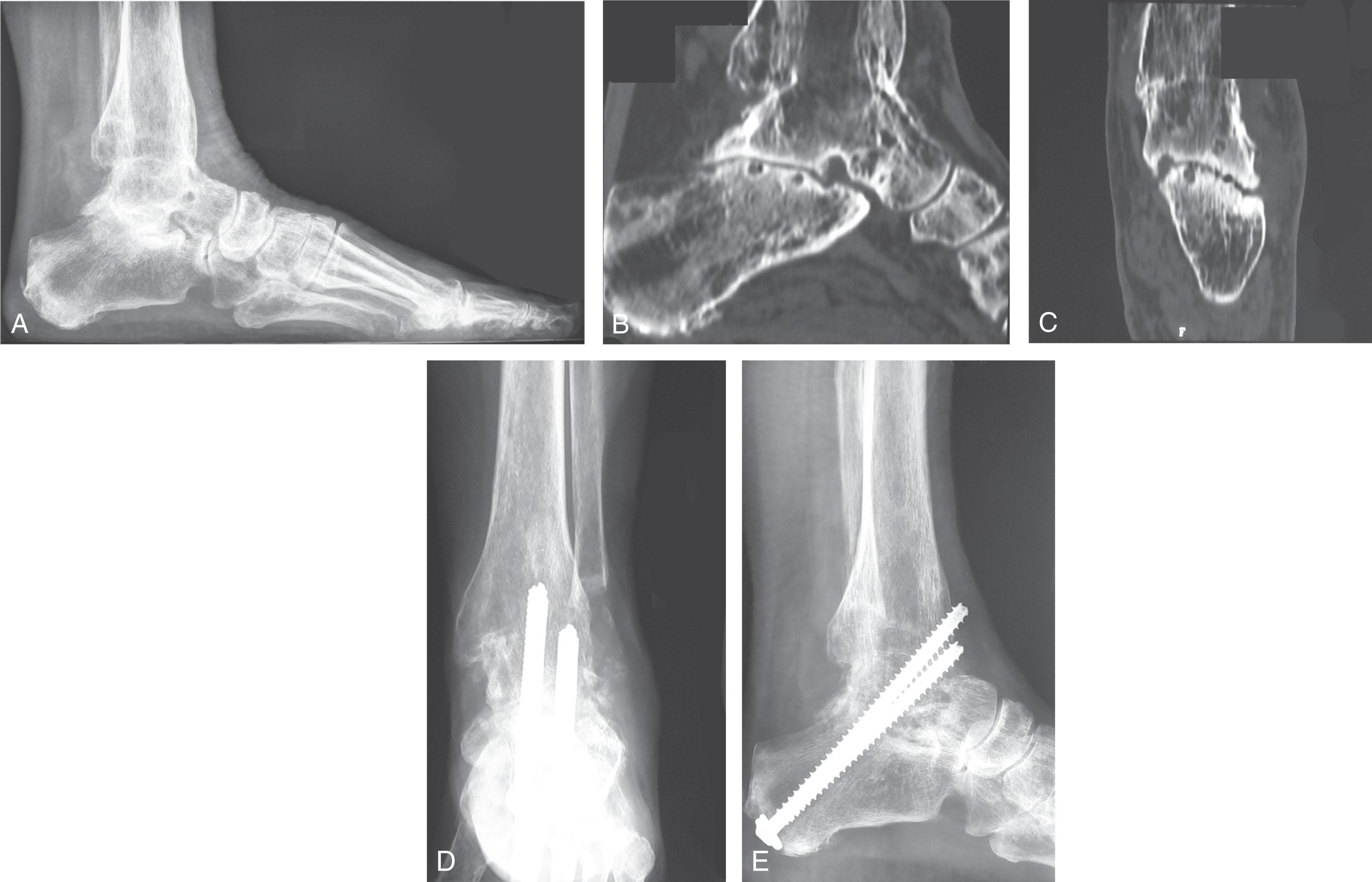 Fig. 25-2, Subtalar nonunion under prior ankle fusion. A , Lateral radiograph of a patient that had successful ankle fusion, followed by subtalar fusion, and later removal of all hardware, who still has persistent pain. B and C , CT scans showing nonunion of the subtalar joint. D and E , Anteroposterior and lateral radiographs showing revision subtalar fusion. Screws are positioned taking advantage of the prior ankle fusion.