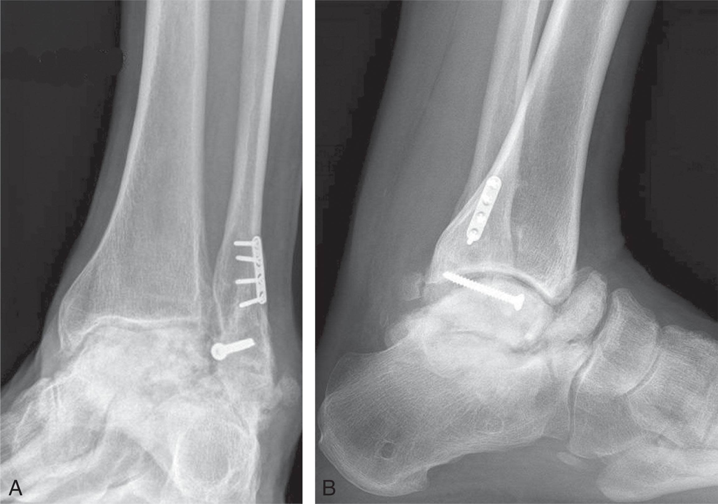 Fig. 25-3, Posttraumatic avascular necrosis of the talus. Anteroposterior (A) and lateral (B) views showing avascular necrosis of the talus after a displaced talar neck fracture. The subtalar joint is arthritis while the ankle is relative well preserved. In these circumstances, hindfoot fusion can be challenging due to the disrupted blood supply to the bone at the fusion site.