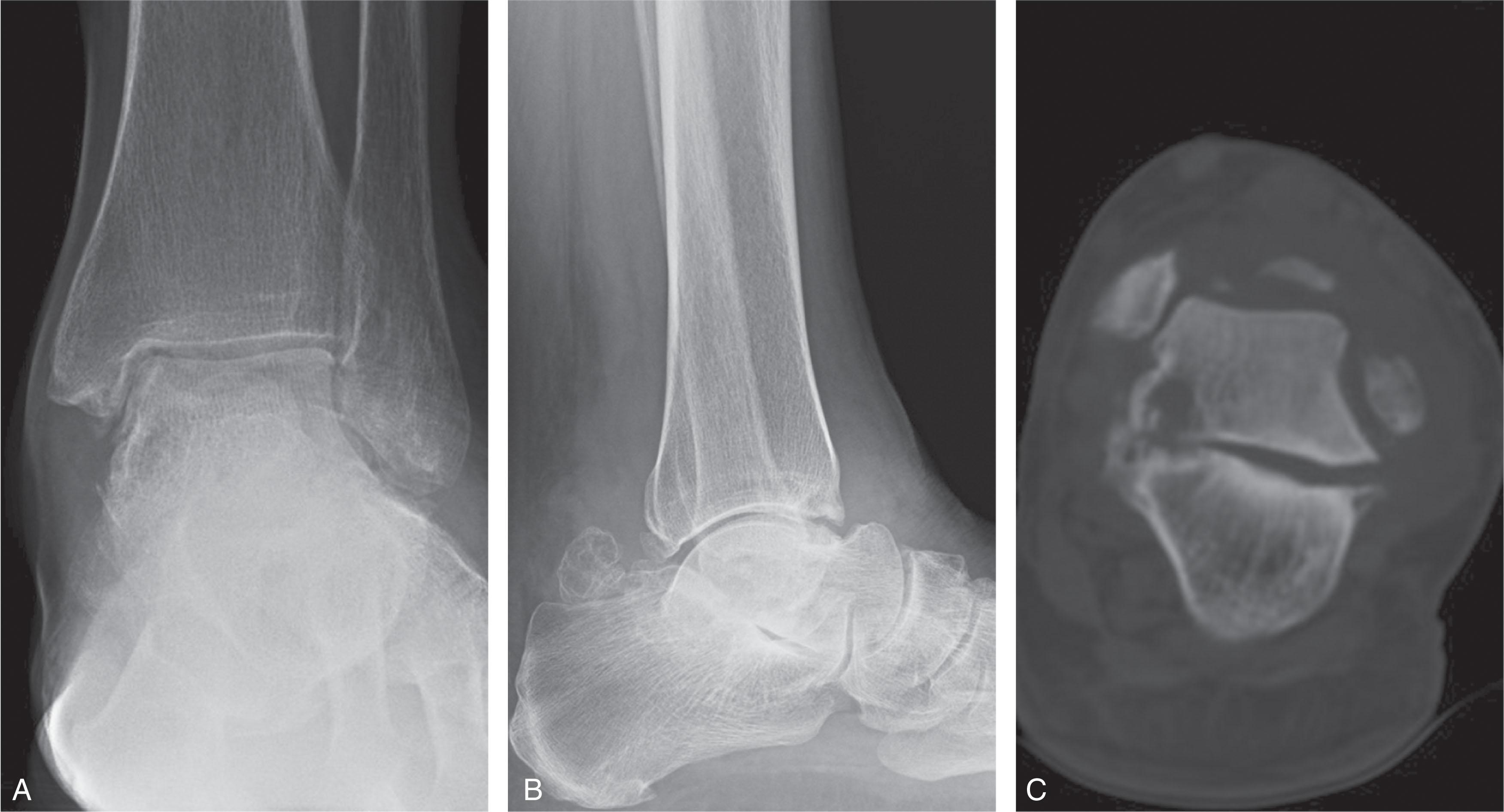 Fig. 25-4, Subtalar arthritis associated with a hindfoot coalition. A and B , Anteroposterior and lateral radiographs showing subtalar coalition of the middle facet leading to subtalar joint arthritis. C , Coronal CT scan through the middle facet showing the coalition.