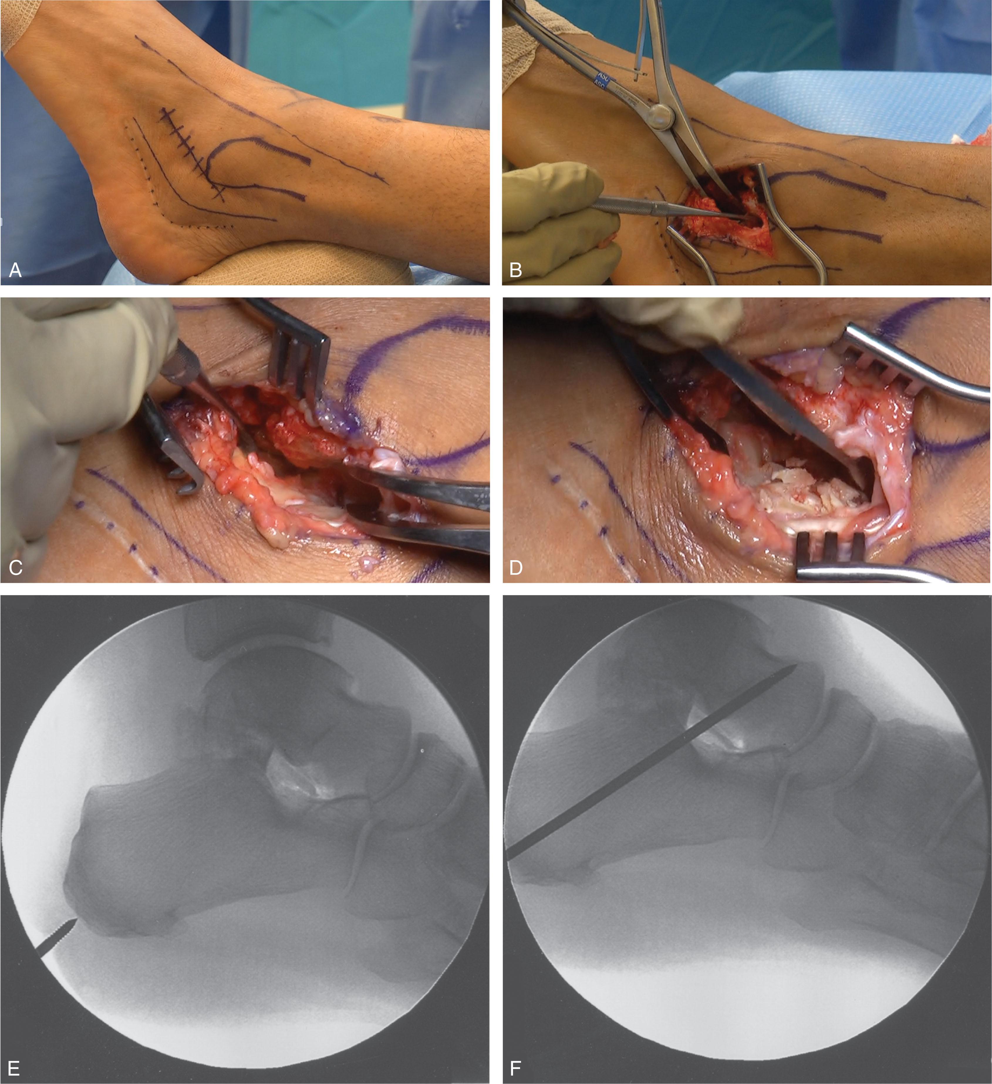 Fig. 25-5, Subtalar fusion technique. A , Skin markings showing the lateral malleolus, prior calcaneal incision (dotted line) , sural and superficial peroneal nerves (solid lines) , and skin incision (hatched line) . The incision runs from the lateral malleolus tip toward the base of the fourth metatarsal. B , A lamina spreader is in the sinus tarsi, and the elevator is in the posterior facet of the subtalar joint. C , The lamina spreader is now in the posterior facet and the elevator is in the middle facet of the subtalar joint at the medial and anterior aspect of the sinus tarsi. D , An osteotome is used to scale the talar and calcaneal surfaces of the posterior facet. E , Fluoroscopy is used to identify the starting position for screw fixation at the posterior-inferior aspect of the calcaneus. Notice the bone wedge placed in the subtalar joint to help correct a severe planovalgus deformity. F , A cannulated screw guidewire is driven across the calcaneus into the talar neck region. G , The guidewire is aimed slightly medially to be sure it is centered in the talar neck, as seen on an anteroposterior ankle fluoroscopy view. H , An optional second guidewire is passed lateral to the first into the talar body. I , The core-diameter drill has already been passed over the first guidewire, and the thread-diameter drill is now used to over-drill the calcaneus only. Notice the guidewire has been tapped through the anterior skin and grasped to prevent it from falling out after drilling. J , The fully threaded cannulated screw with a washer has been used to compress the subtalar joint, and a core-diameter drill is passed into the talar body. K and L , Lateral and anteroposterior views showing the two screws across the subtalar joint fusion.