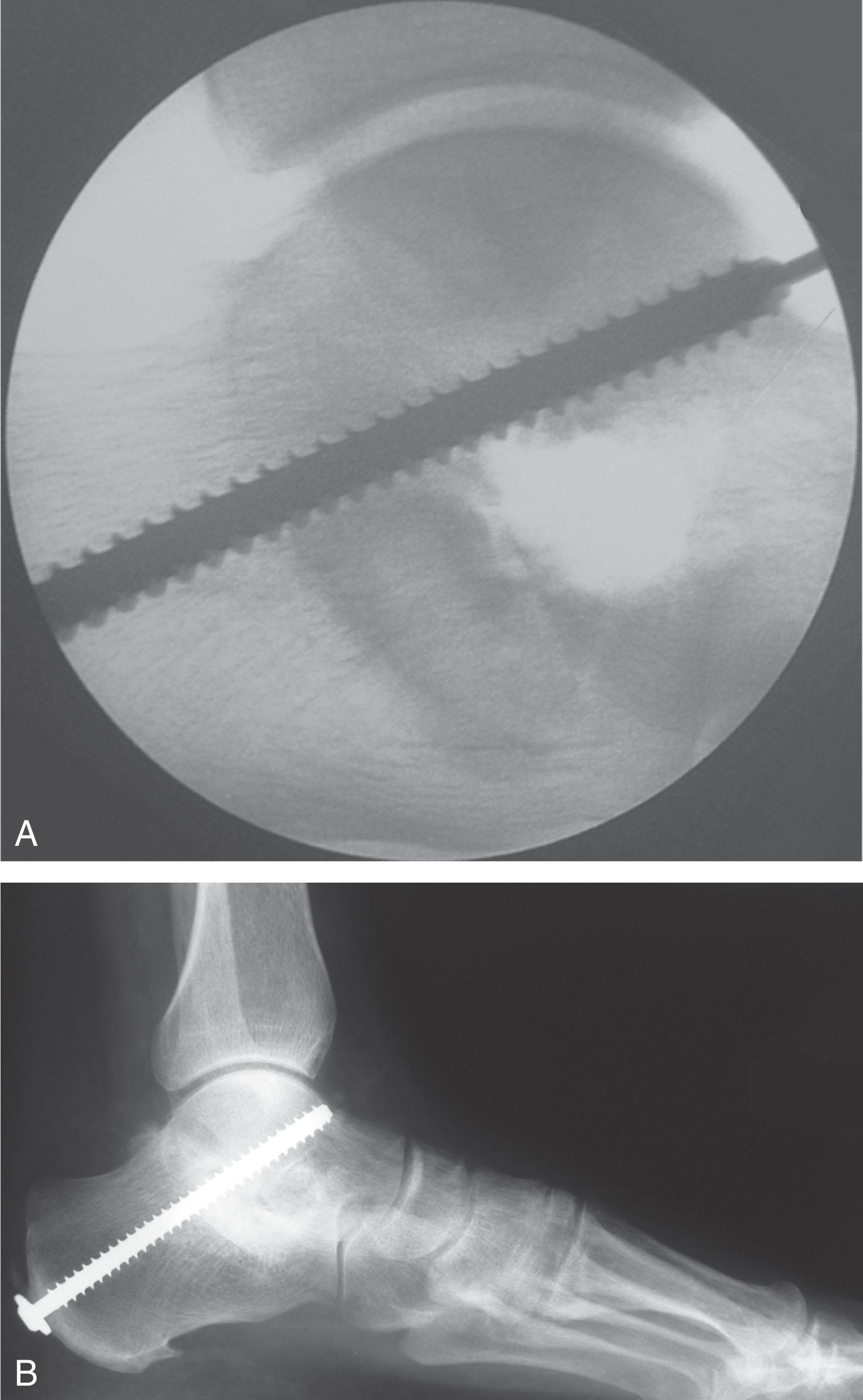 Fig. 25-6, Single screw subtalar fusion. A , Intraoperative fluoroscopy showing a 7.3-mm cannulated screw guidewire crossing the far anterior aspect of the posterior facet as it traverses into the talar neck, avoiding the talar articular surface. B , Postoperative lateral radiograph showing a healed subtalar fusion using a single screw. Notice how bone graft placed in the sinus tarsi has contributed to the overall fusion area.