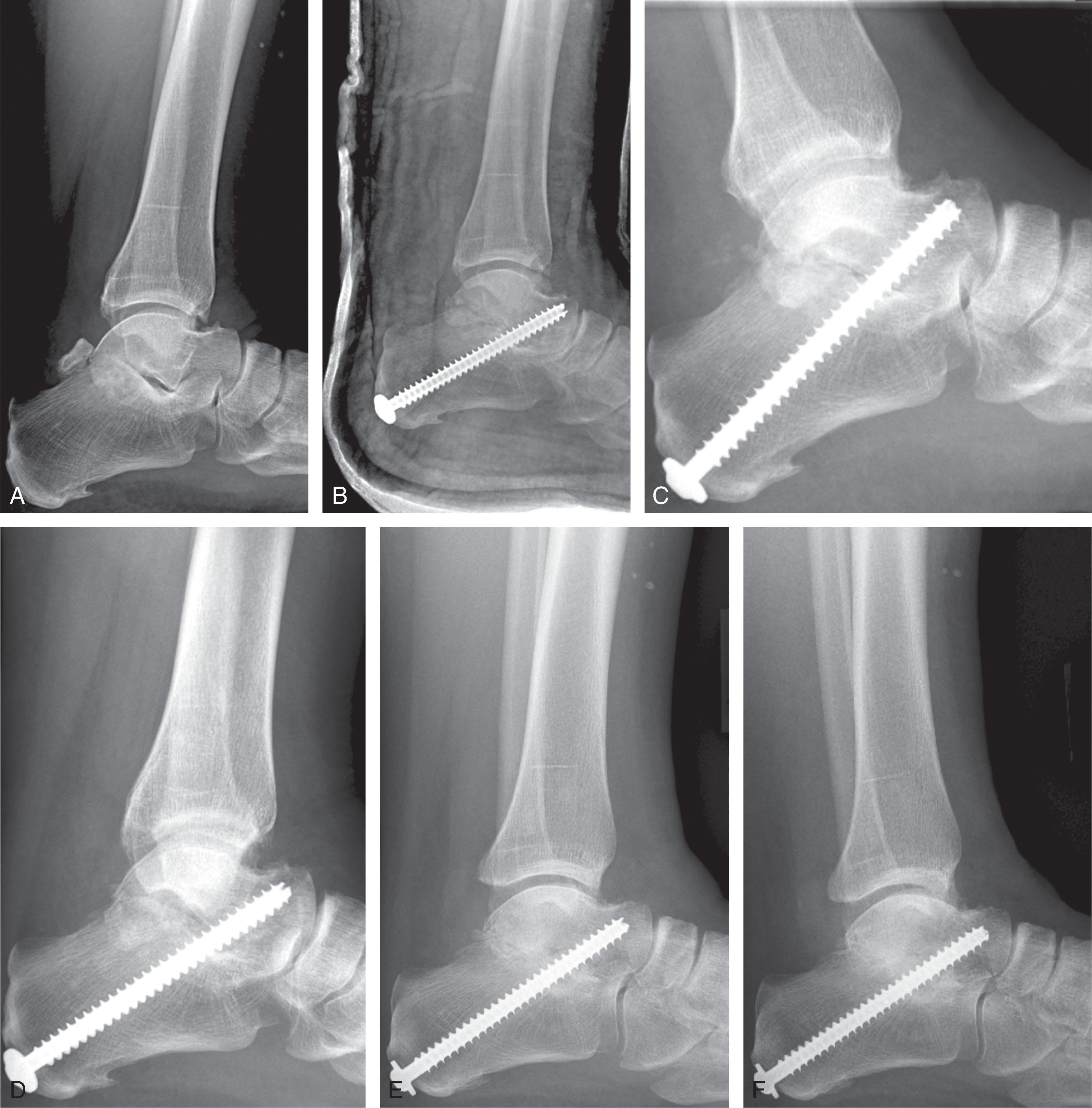 Fig. 25-7, Healing of a subtalar fusion over one year. Lateral radiographs showing the subtalar joint before subtalar fusion (A) ; 2 weeks after fusion (B) ; 6 weeks after fusion (C) ; 12 weeks after fusion (D) ; 6 months after fusion (E) ; and 12 months after fusion (F) demonstrating progressive healing of the subtalar joint.