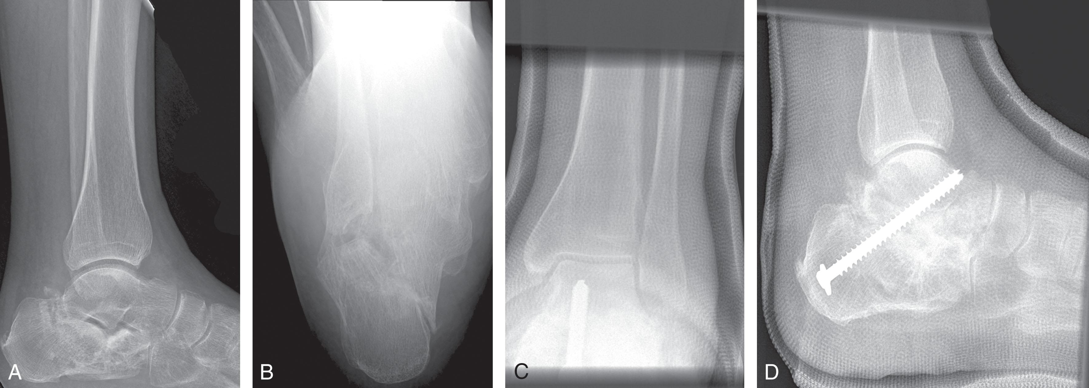 Fig. 25-8, Distraction subtalar arthrodesis for calcaneal malunion and subtalar arthritis. A and B , Lateral and axial views of calcaneal fracture malunion with loss of calcaneal height. C and D , Anteroposterior and lateral views after distraction subtalar fusion using a bone block to restore calcaneal height and restore talar inclination.