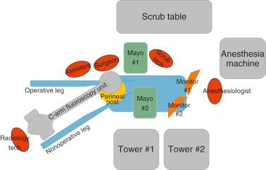 Fig. 79.1, Diagram illustrating room set-up for right-side hip arthroscopy.