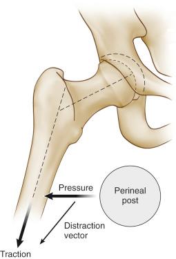 Fig. 52.2, The optimal vector for distraction is oblique relative to the axis of the body and more closely coincides with the axis of the femoral neck than the femoral shaft. This oblique vector is partially created by abduction of the hip and is partially accentuated by a small transverse component to the vector created by lateralizing the perineal post.