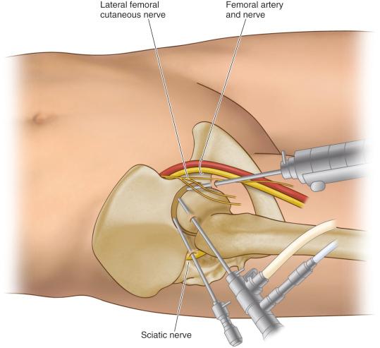 Fig. 52.4, The relationship of major neurovascular structures to the 3 standard portals is demonstrated. The femoral artery and nerve lie well medial to the anterior portal. The sciatic nerve lies posterior to the posterolateral portal. Small branches of the lateral femoral cutaneous nerve lie close to the anterior portal. Injury to these is avoided by utilizing proper technique in portal placement. The anterolateral portal is established first because it lies most centrally in the safe zone for arthroscopy.