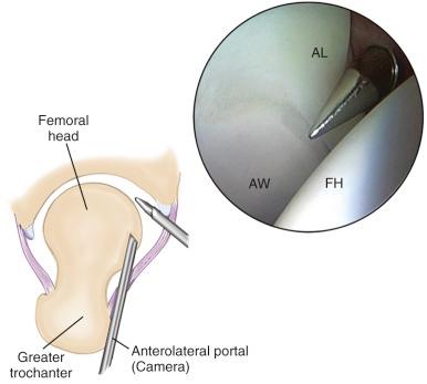 Fig. 52.6, Arthroscopic view of a right hip from the anterolateral portal demonstrates the anterior acetabular wall (AW), anterior labrum (AL), and femoral head (FH). The anterior cannula is seen entering underneath the labrum.