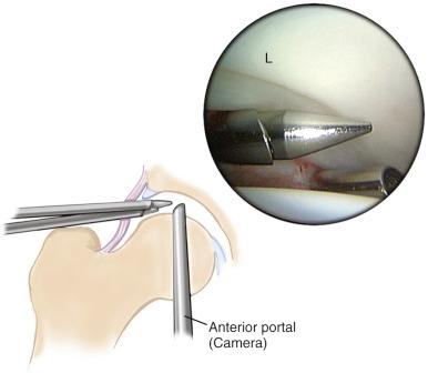 Fig. 52.7, Arthroscopic view from the anterior portal demonstrates the lateral aspect of the labrum (L) and its relationship to the lateral 2 portals.