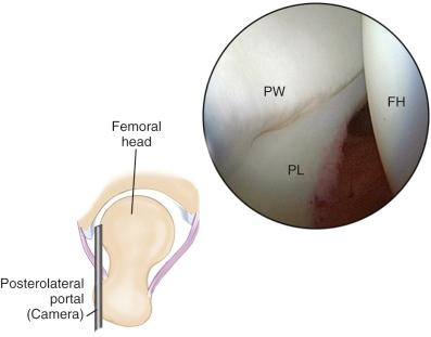 Fig. 52.8, Arthroscopic view from the posterolateral portal demonstrates the posterior acetabular wall (PW), posterior labrum (PL), and femoral head (FH).