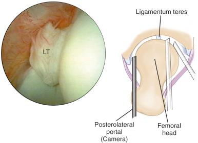 Fig. 52.9, The acetabular fossa can be inspected from all 3 portals to view the ligamentum teres (LT) with its accompanying vessels traversing in a serpentine fashion from its more posteriorly placed acetabular attachment.