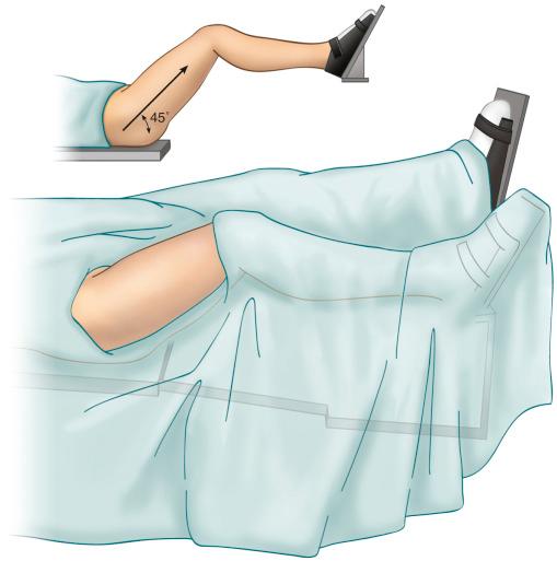 Fig. 52.10, The operative area remains covered in sterile drapes while traction is released and the hip is flexed 45 degrees. Inset: Illustration of the position of the hip without the overlying drape.