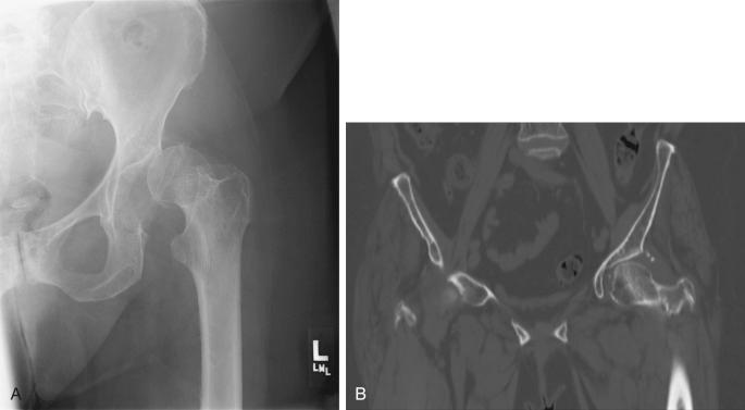 Fig. 52.12, The obturator oblique radiograph brings the anterior column and posterior wall of the acetabulum into profile.