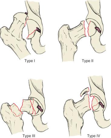 Fig. 52.15, The displaced posterior wall fragment (A) is demonstrated on the computed tomography (CT) scan (B) to encompass a major portion of the posterior articular surface. The sagittally reconstructed CT view further elucidates the extent of the fracture and demonstrates a fracture fragment interposed between the femoral head and the acetabulum.