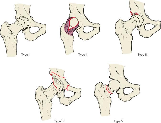 Fig. 52.17, Magnetic resonance imaging of a hip after acute fracture-dislocation. (A) The axial view demonstrates a posterior wall fracture. (B) The sagittal image demonstrates a superior labral tear.