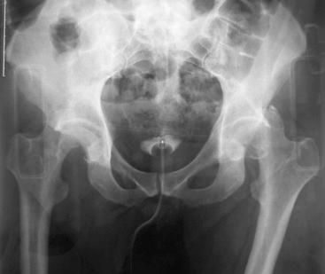 Fig. 52.3, Bilateral hip dislocations were sustained by an unrestrained intoxicated driver. Both hips were dislocated posteriorly with associated anterior femoral head fractures.