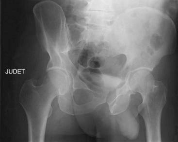 Fig. 52.8, Levin comprehensive classification of posterior hip dislocations (see Table 52.2 ).