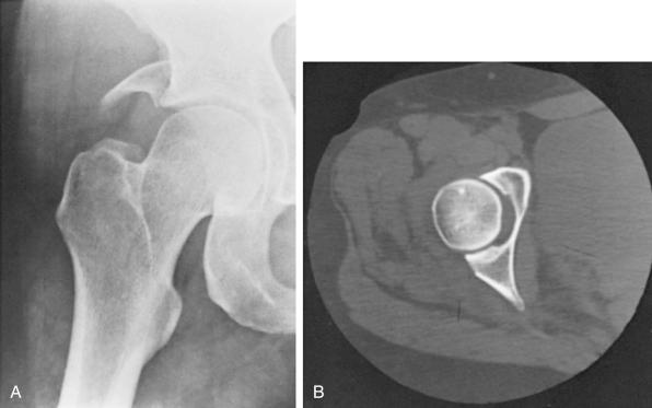 Fig. 52.10, Anterior dislocation of the hip. Notice that the leg is widely abducted and externally rotated.