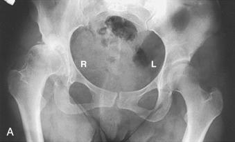 Fig. 76.2, The Hartofilakidis dysplastic hip. Radiograph (A) and line drawing (B) of a 28-year-old woman who had a right-hand sided dysplastic hip.