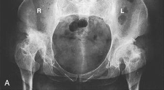 Fig. 76.3, The Hartofilakidis low-dislocation right hip and dysplastic left hip. (A) A 44-year-old woman who had bilateral congenital hip disease. (B) Line drawing of the same hips showing the differences between a low-dislocation hip and a dysplastic hip with approximately the same degree of subluxation.