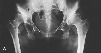 Fig. 76.4, The Hartofilakidis high dislocation. Radiograph (A) and line drawing (B) of a 42-year-old woman who had a high dislocation of the hip on the right and a low dislocation on the left.