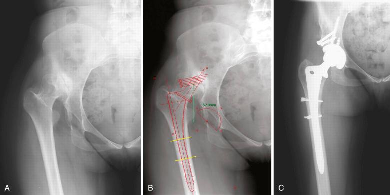 Fig. 76.5, (A) A 30-year-old woman with severe pain in the right hip and no previous surgery on that hip. (B) Radiograph demonstrating the preoperative templating process. (C) Anteroposterior radiograph made 2 years postoperatively.