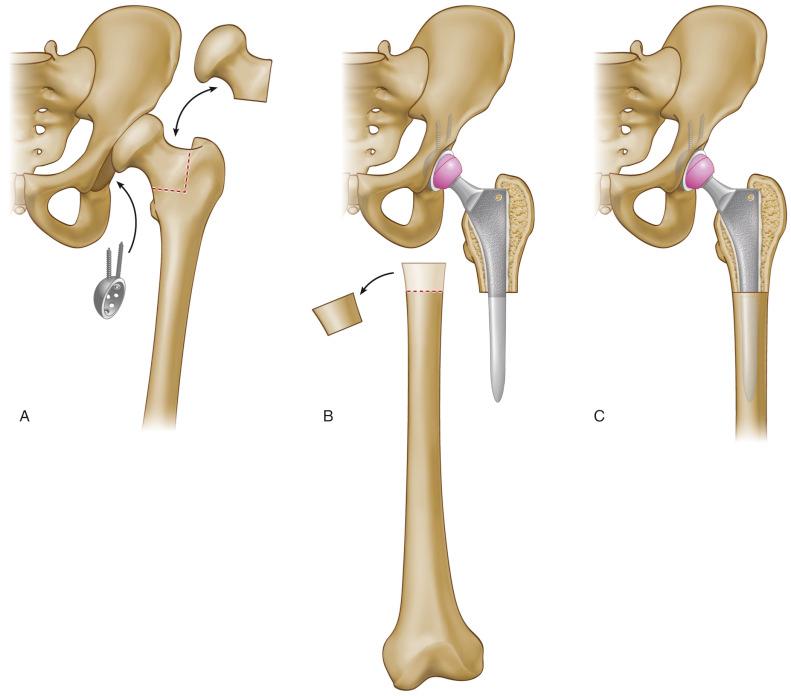 Fig. 76.6, (A) Femoral head osteotomy is followed by acetabular resurfacing. (B) Femoral preparation, subtrochanteric osteotomy, and reduction of the proximal hip segment allow assessment of the femoral bone overlap, which defines the amount of shortening required. (C) The osteotomy is transfixed by the long-stem implant, and the hip is reduced.