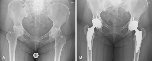 Fig. 106.2, (A) Preoperative anteroposterior radiograph demonstrating end-stage arthrosis of bilateral hips. (B) Postoperative anteroposterior radiograph demonstrating bilateral total hip arthroplasty with equal leg lengths and femoral offset restoration.