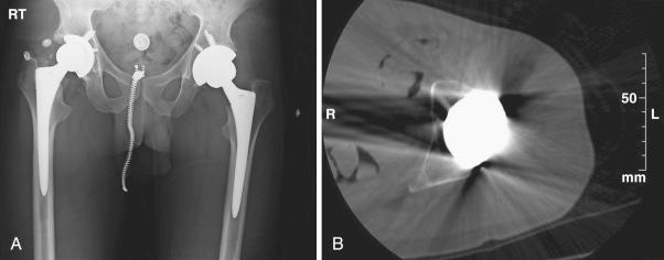 Fig. 106.5, (A) Anteroposterior radiograph of the pelvis of a 32-year-old male patient referred for chronic instability of the left hip. Acetabular inclination is 40 degrees with version that appears neutral or retroverted. Note the limb length inequality, with the left side being 1.3 cm longer than the right and with offset that is 1.2 cm greater than the right side. This case illustrates how intraoperative instability can lead to leg length inequality and increased offset in attempts to gain stability; acetabular malposition is usually the underlying cause. (B) Axial computed tomography scan of the patient, demonstrating acetabular component retroversion.