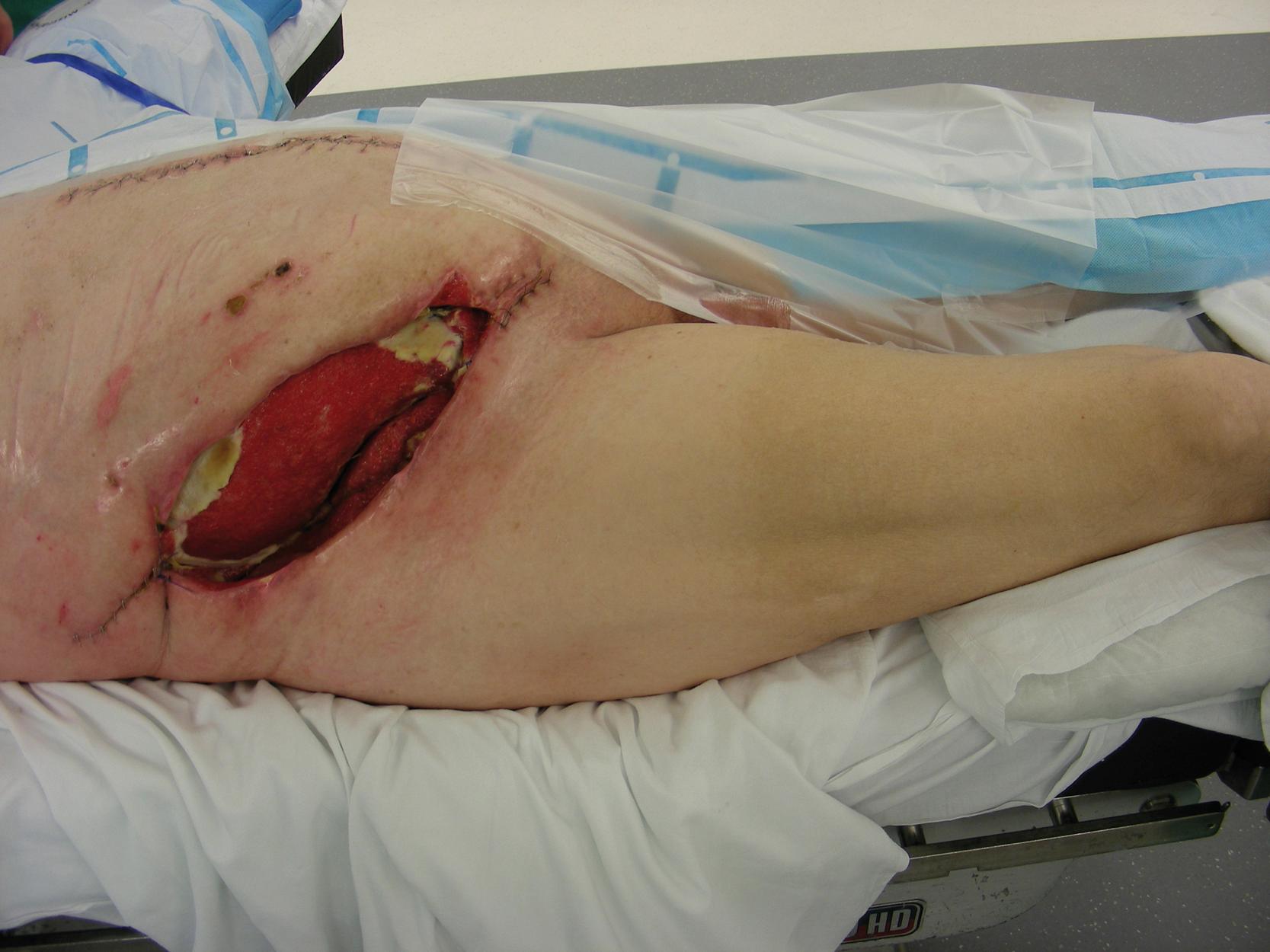 Fig. 31.1, A preoperative view showing a large and complex hip and pelvic wound with exposed deep pelvic structures.