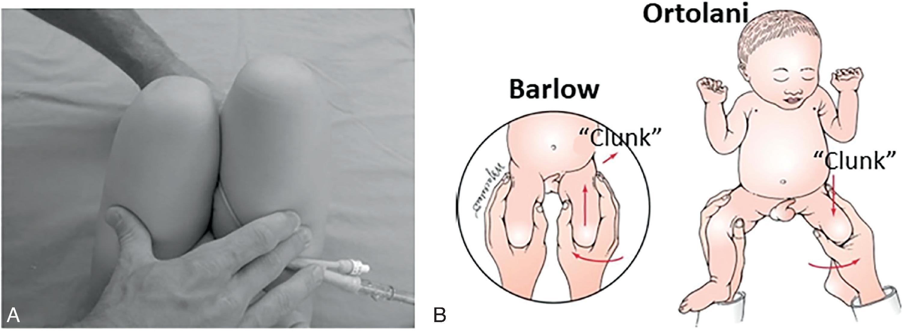 Fig. 73.1, Developmental Dysplasia of the Hip .