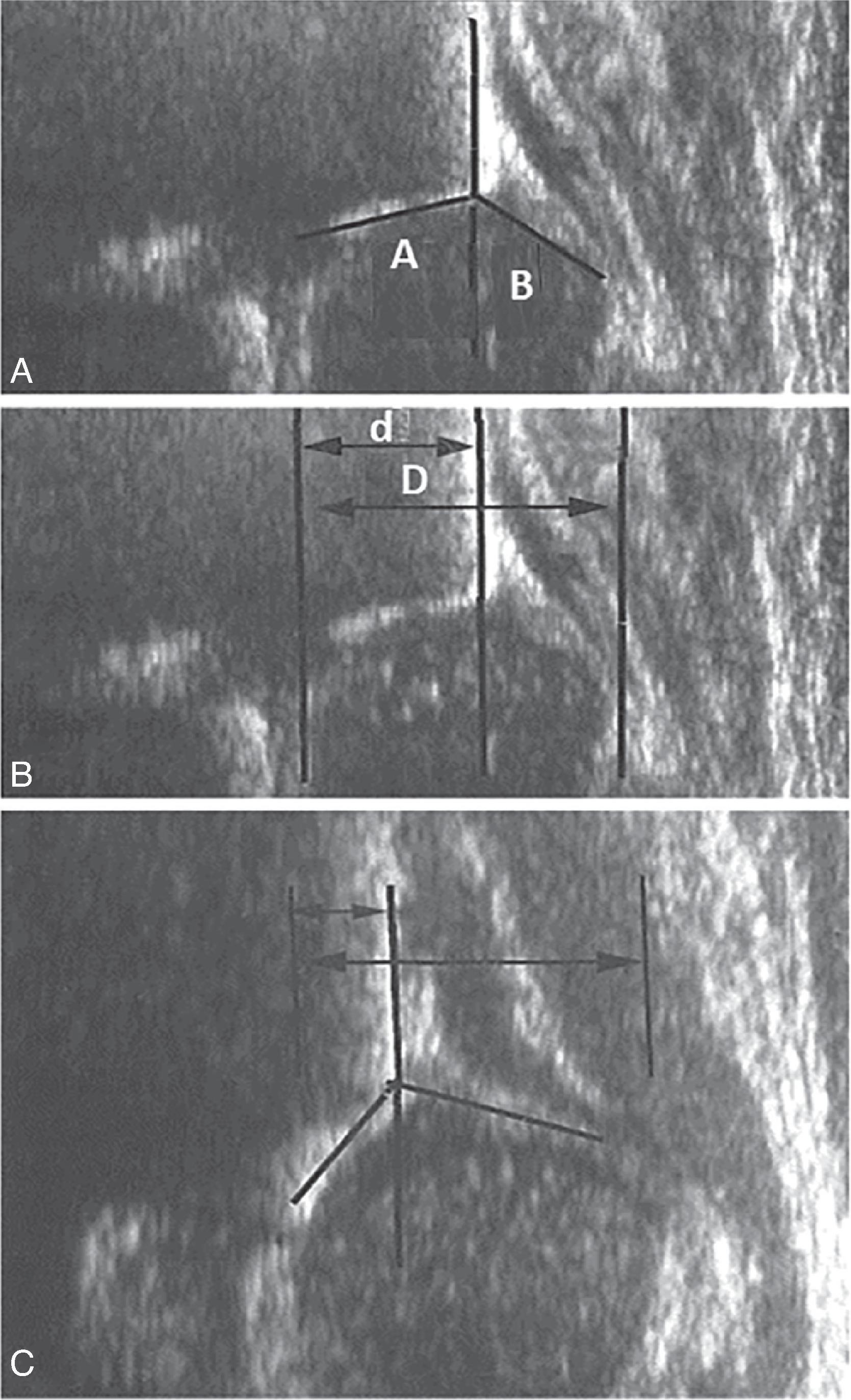 Fig. 73.2, Standard Coronal Plane Ultrasonogram of a Normal Infant’s Hip .