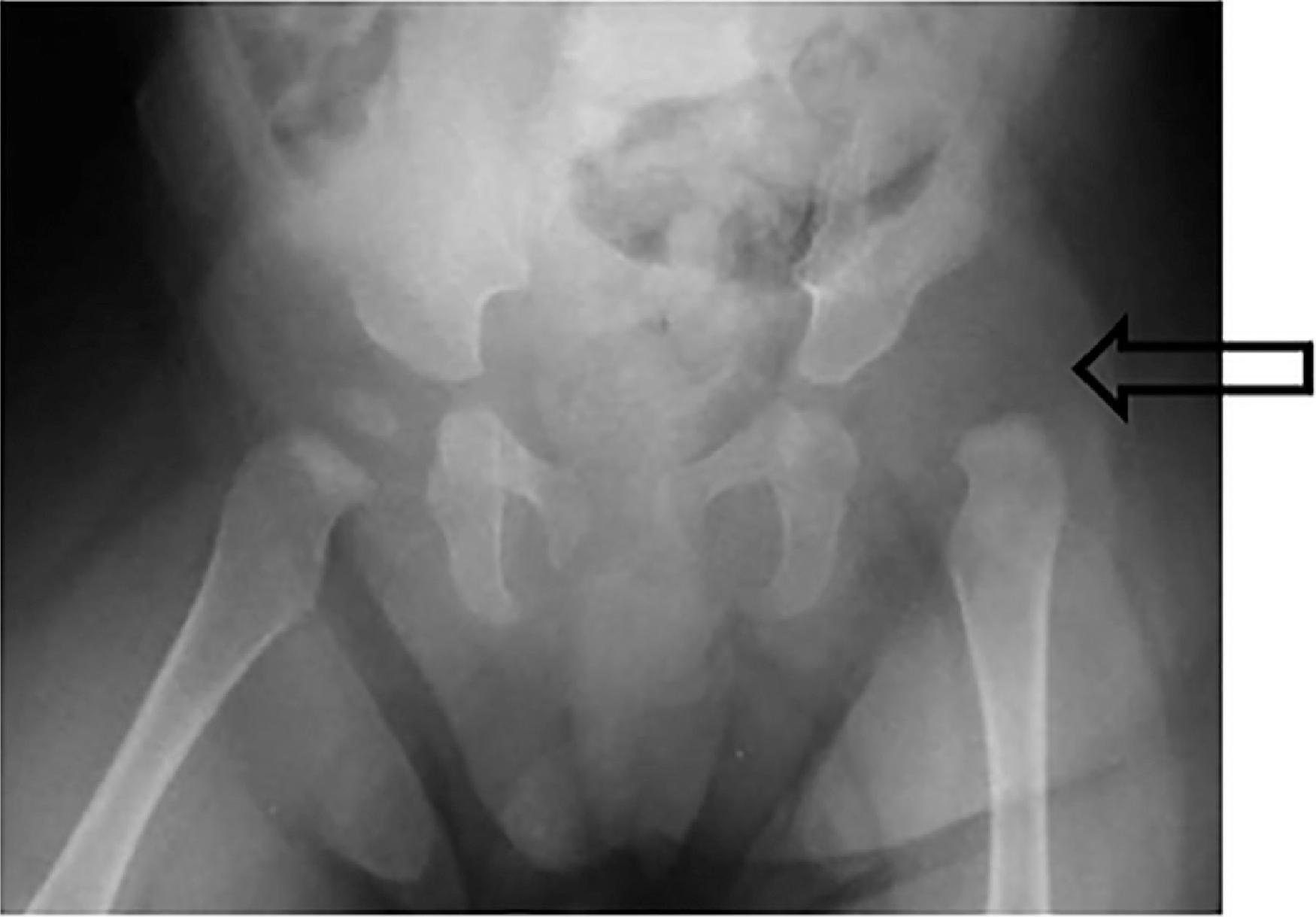 Fig. 73.3, Anteroposterior Radiograph of a 6-Month-Old Infant With Developmental Dysplasia of the Hip .