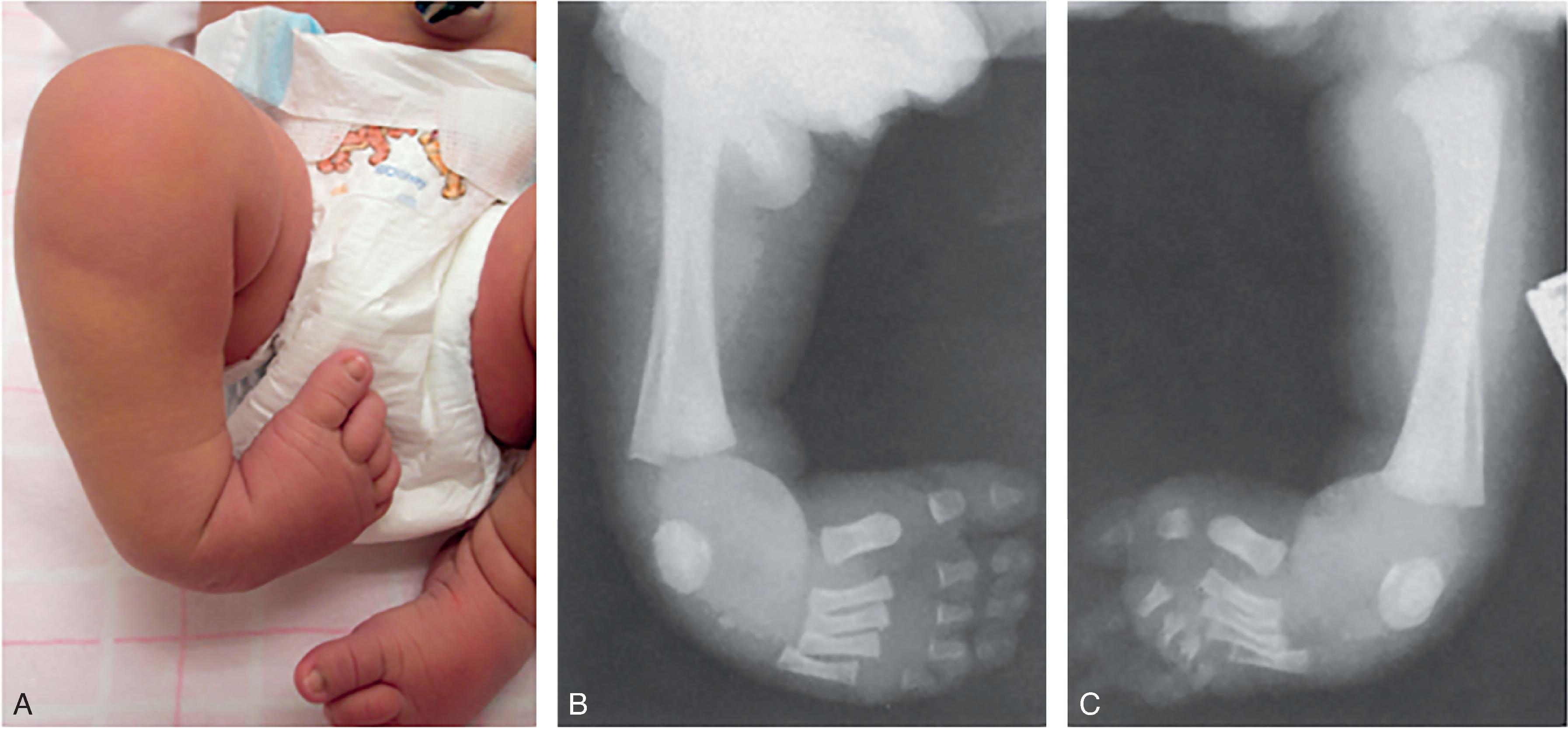 Fig. 73.6, Talipes Equinovarus in a Newborn .