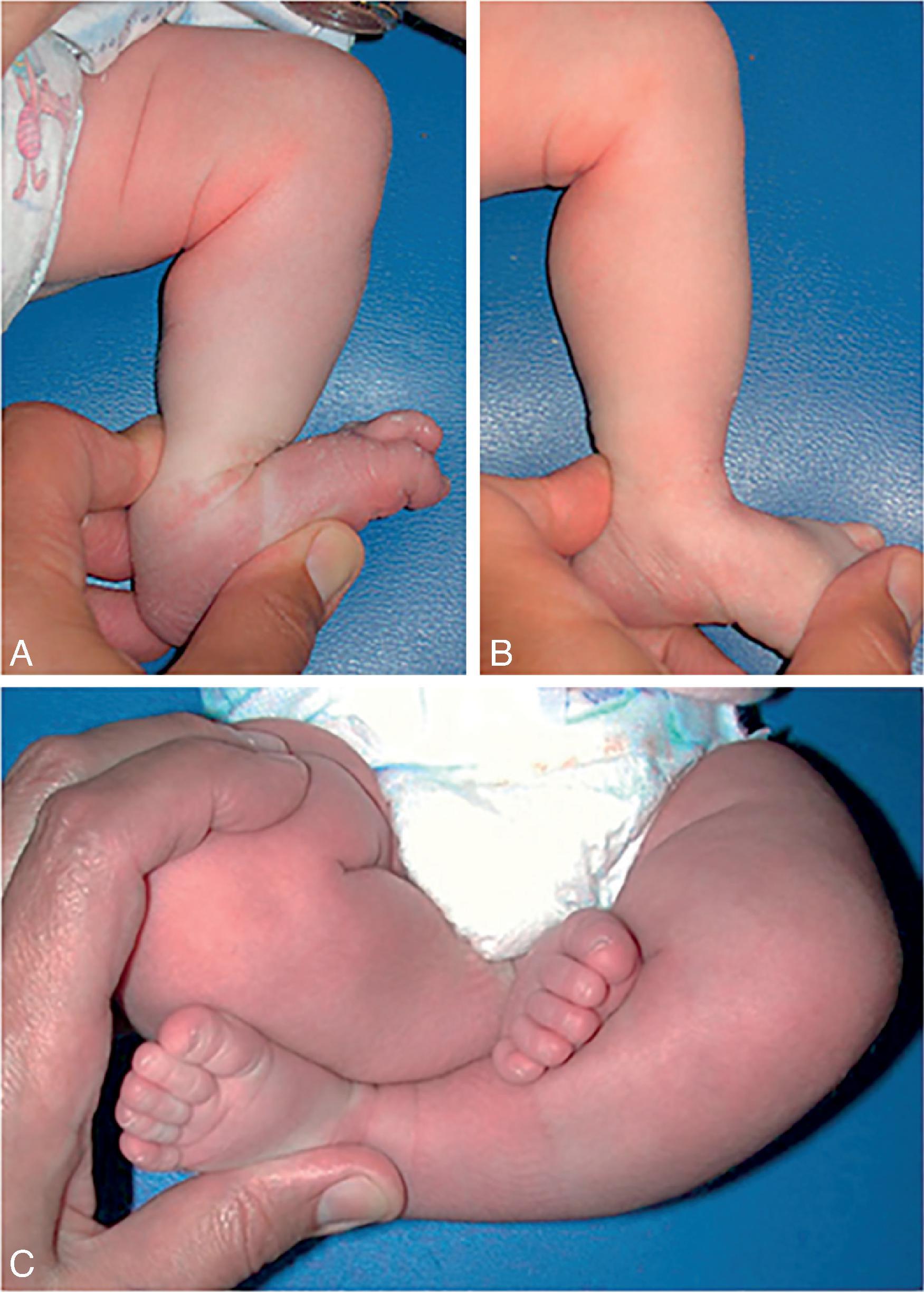 Fig. 73.7, Clinical picture of a calcaneovalgus foot (A) that is passively correctable (B) because of intrauterine positioning (C).