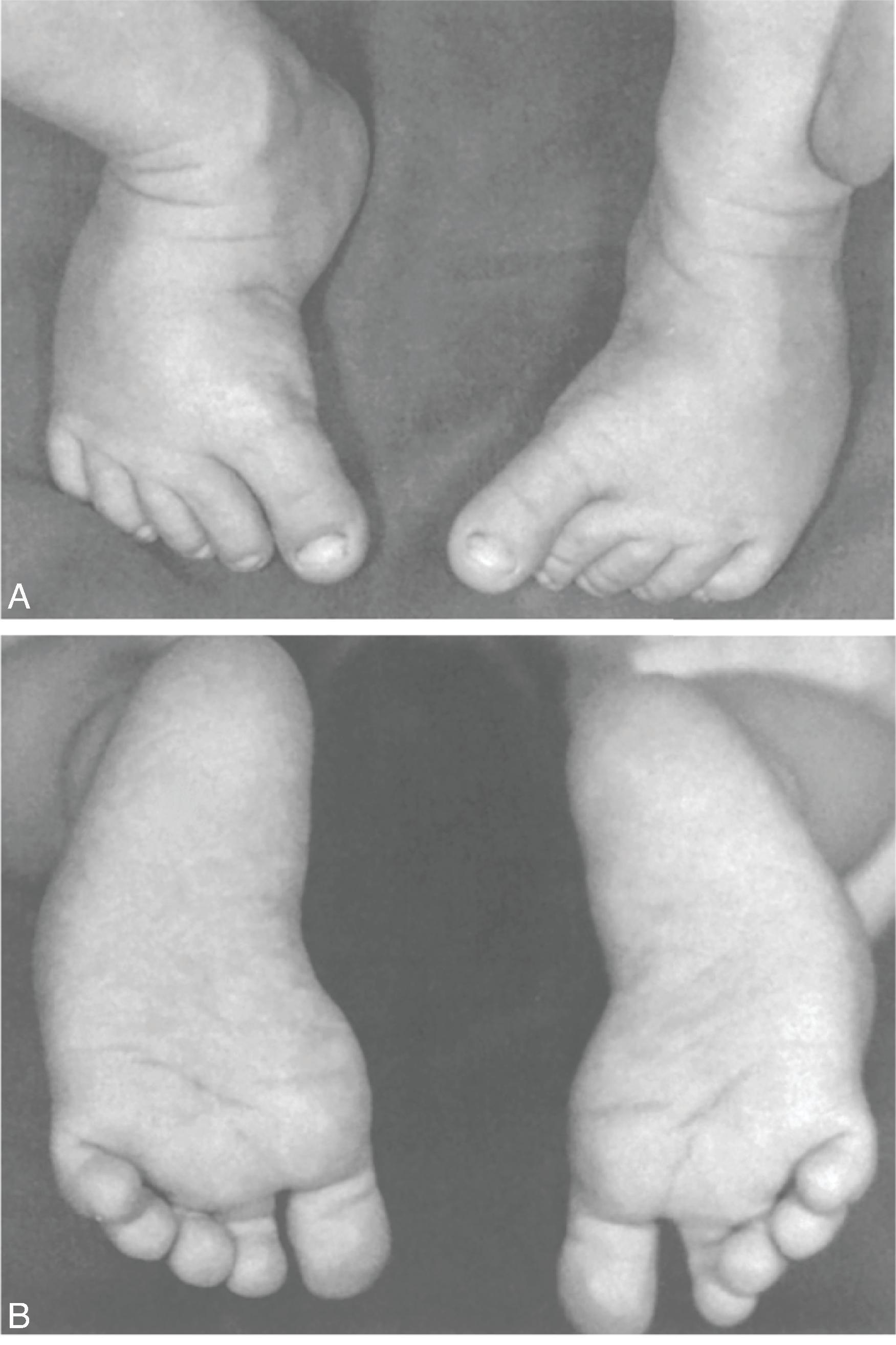 Fig. 73.8, Bilateral Mild Metatarsus Adductus .