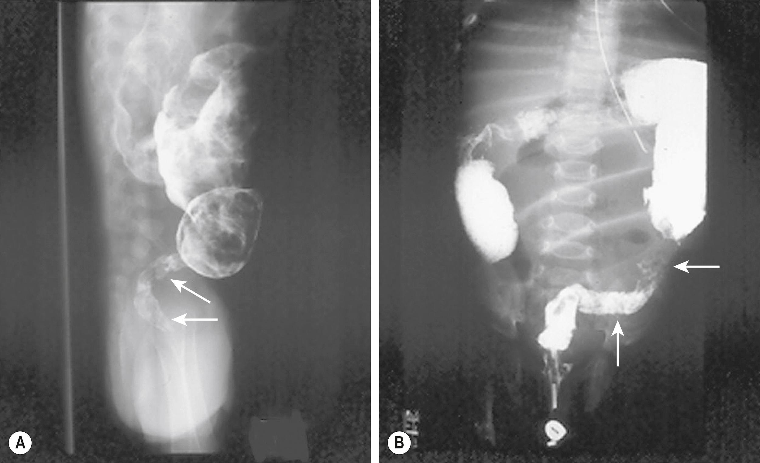 Fig. 34.1, (A) and (B) represent contrast enema examinations in different infants demonstrate Hirschsprung disease. The aganglionic rectum (arrows in both studies) is small and contracted. The proximal ganglionic colon is dilated. A transition zone between the aganglionic and ganglionic colon is nicely seen in both studies.