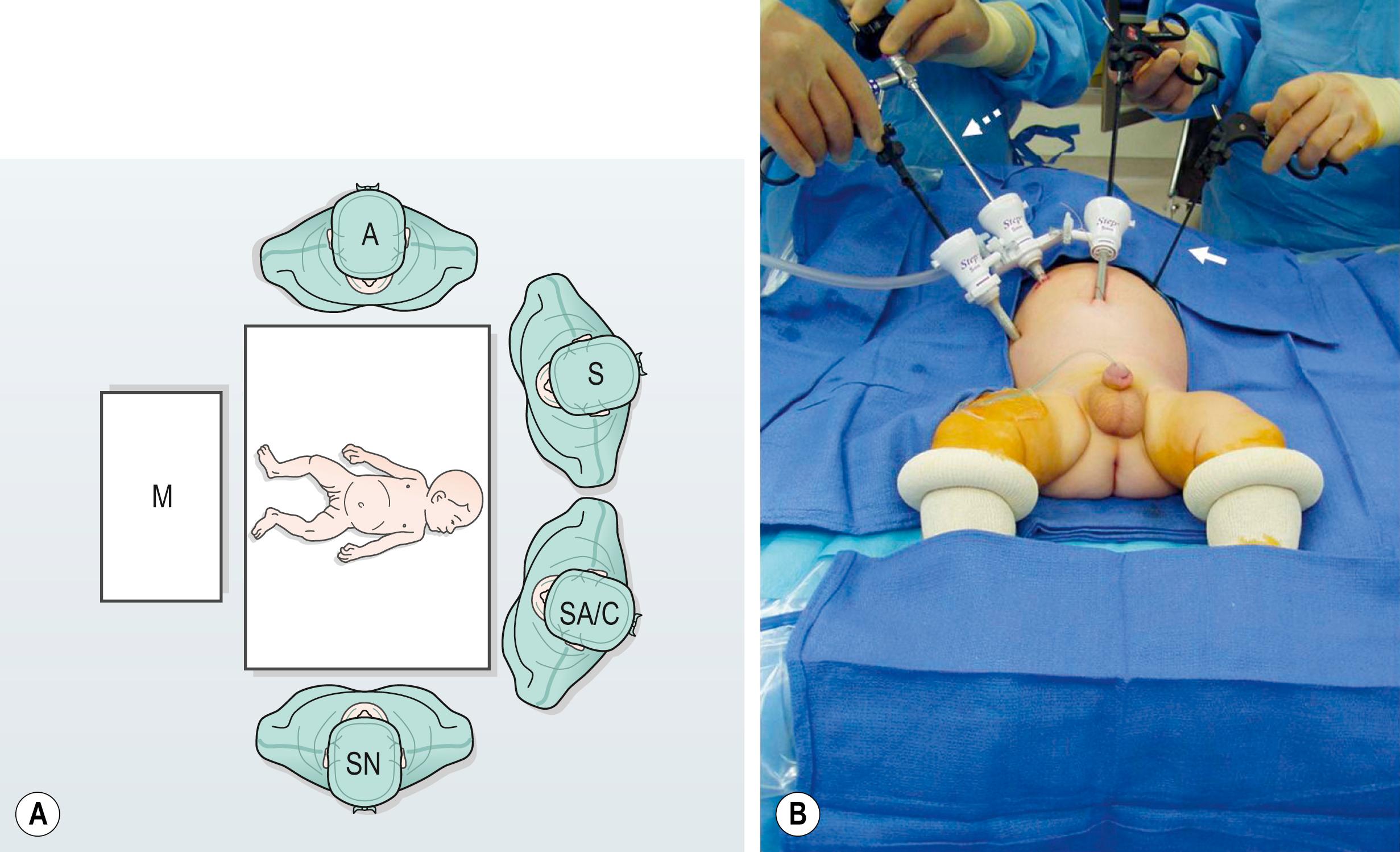 Fig. 34.11, (A) The surgeon (S) and surgical assistant/camera holder (SA/C) stand above the patient’s head with the monitor (M) positioned beyond the infant’s feet. The scrub nurse (SN) can be positioned according to the surgeon’s preference, although being positioned at the foot of the operating table appears to be ideal. A, anesthesiologist. (B) The photograph shows port placement for this operation. Usually three or four ports are required. The umbilical port is inserted using an open technique, and the other ports are introduced under direct visualization. The telescope (dotted arrow) is placed through the 5-mm port in the right upper abdomen. The surgeon’s two primary working ports are the umbilical port for the left hand and the right lower abdominal port for the right hand. A retracting instrument (solid arrow) is often helpful and can be inserted through a stab incision in the infant’s left upper abdomen. A urinary catheter has been introduced to help decompress the bladder.