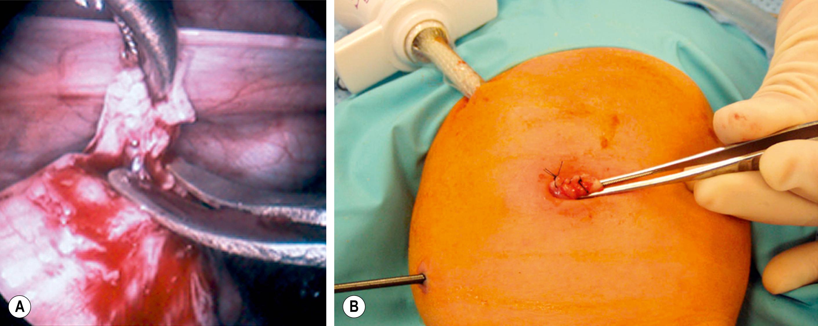 Fig. 34.12, (A) An intracorporeal biopsy is being performed on the sigmoid colon. A fine-tipped grasping forceps has been used to grasp the biopsy site, and Metzenbaum scissors are used to obtain the biopsy specimen. (B) This biopsy was performed through the umbilical incision. One port and another instrument have been introduced through the infant’s abdominal wall. A site on the colon for the biopsy was visualized and delivered just under the umbilical cannula. The umbilical cannula was removed, and this portion of the colon was grasped and exteriorized. An extracorporeal biopsy was obtained, and the biopsy site was closed. This is an alternative means for obtaining the biopsy.