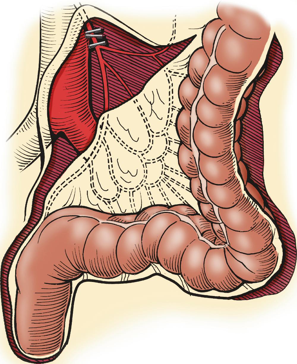 Fig. 34.13, When the transition zone is proximal to the midsigmoid colon, a pedicled colon flap must be developed for the endorectal pull-through. In this situation, the pull-through colon will derive its vascular supply from the marginal artery. Therefore, to mobilize the descending colon and splenic flexure, it is necessary to ligate and divide either the inferior mesenteric artery just distal to its origin from the aorta (as seen in this drawing) or the left colic artery just after it arises from the inferior mesenteric artery. By ligating these vessels at these sites, the arterial supply through the marginal artery is not compromised.