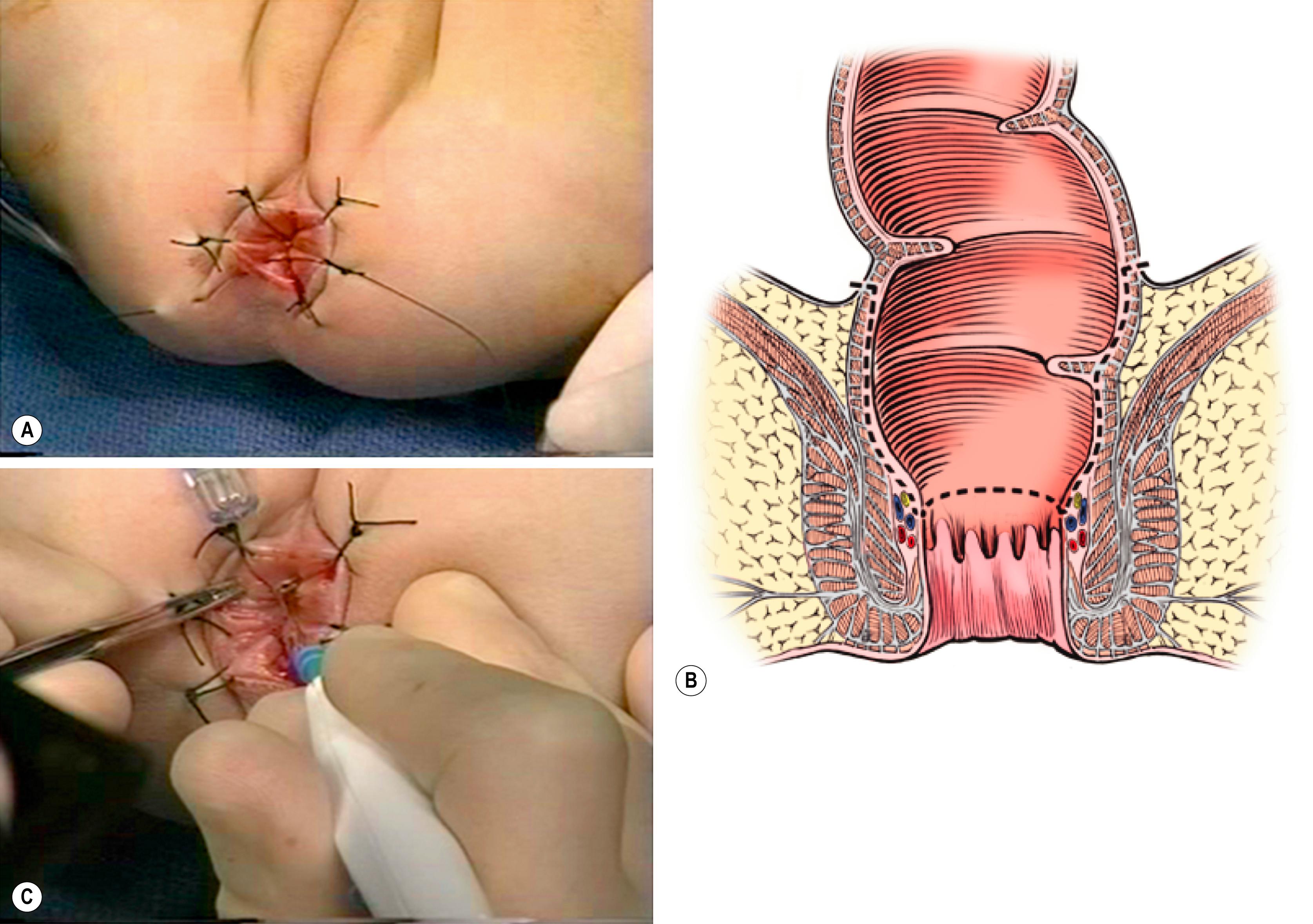 Fig. 34.14, (A) The perineal dissection begins with the placement of circumferential 2-0 silk traction sutures from the dentate line to the perineum 2–3 cm outward from the anus. (B, C) A needle-tipped electrocautery is used to circumferentially incise the rectal mucosa approximately 5 mm proximal to the anal columns. Fine silk traction sutures are then placed in the rectal mucosa to help retract the mucosa during circumferential dissection.