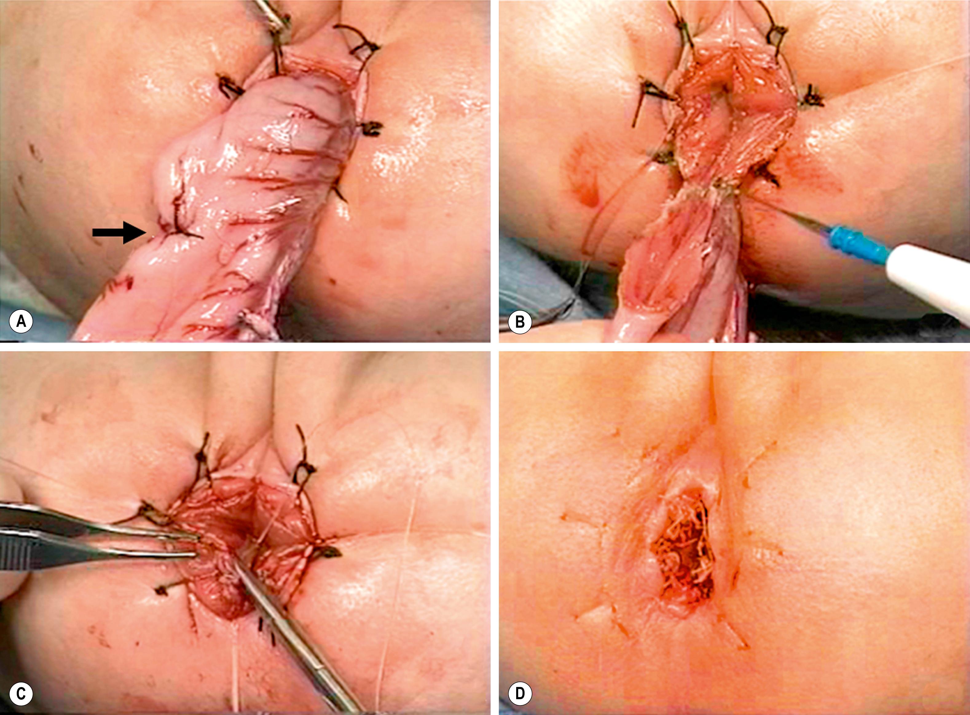 Fig. 34.15, (A) The muscular cuff of the rectum has been divided, and the ganglionic colon has been exteriorized through the anal canal. Note that the anastomosis will be performed proximal to the biopsy site (arrow). (B) The pull-through colon is being completely transected above the biopsy site and made ready for the coloanal anastomosis. (C) The anastomosis is being performed with interrupted 4-0 absorbable sutures. (D) The everting stay sutures have been cut, allowing the anastomosis to retract cephalad.