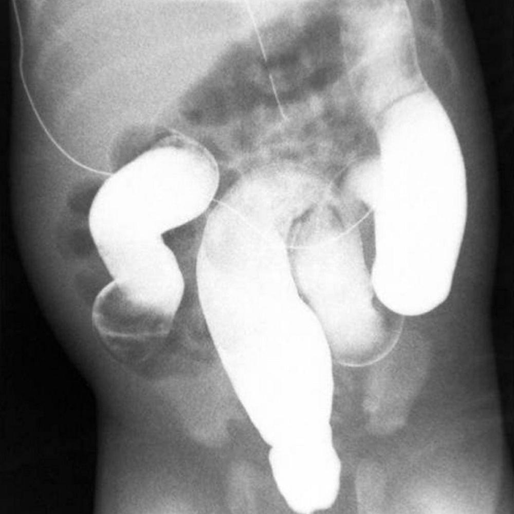 Fig. 34.2, Retention of contrast is seen on this postevacuation film, which was obtained 24 hours after the contrast enema.